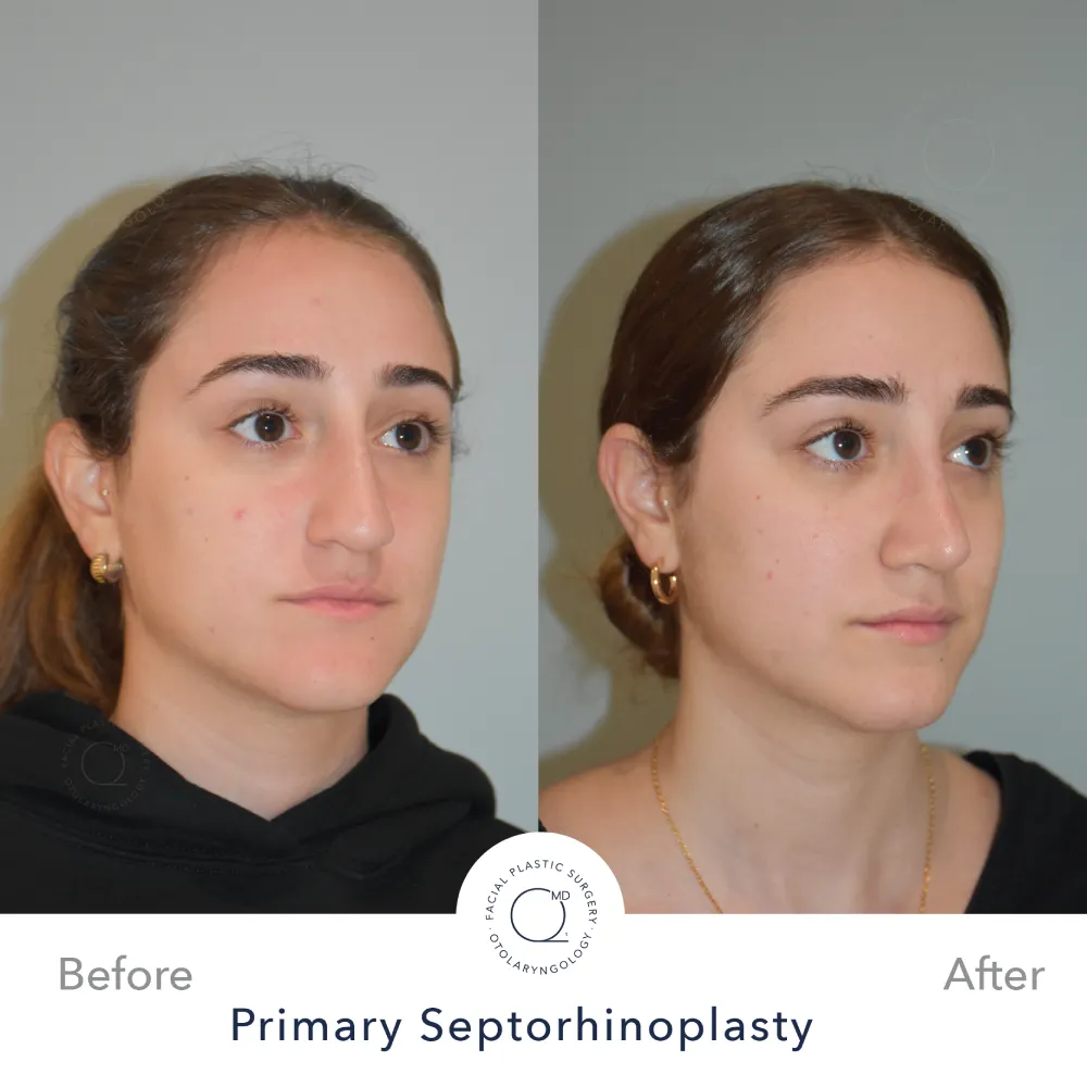 rinoplastia-paciente-perfil-bajo-caso-34