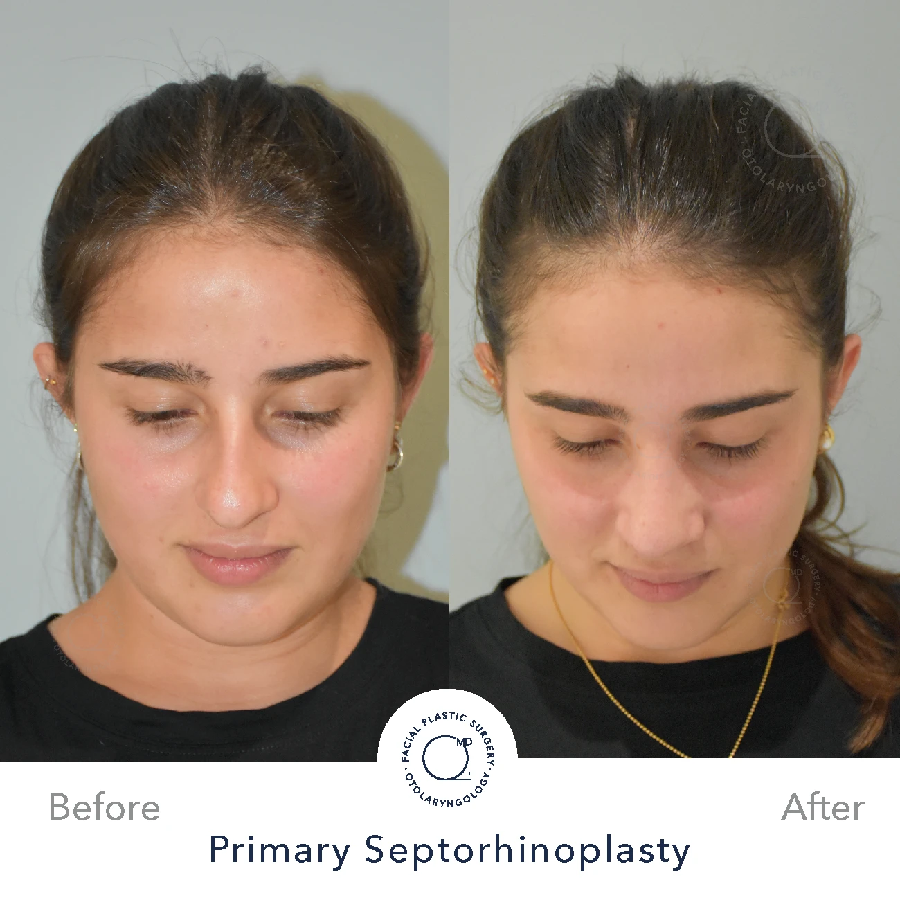 rinoplastia-paciente-perfil-bajo-caso27