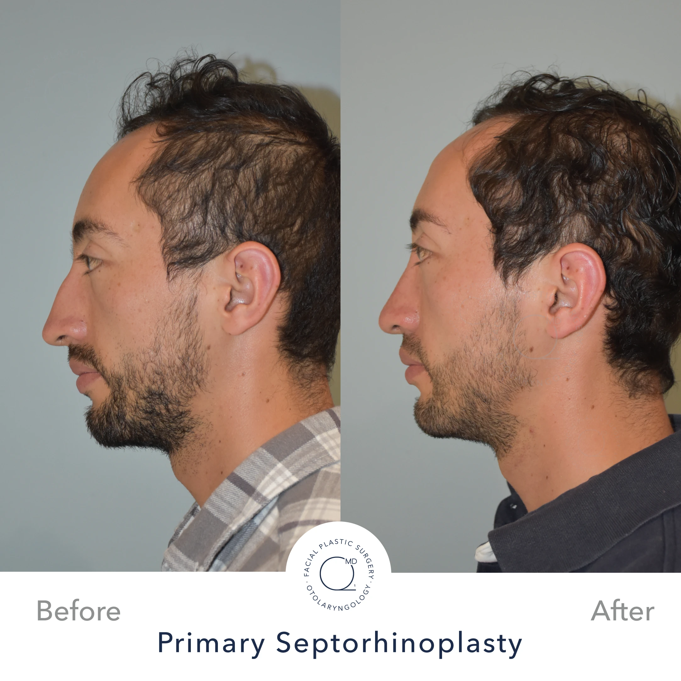 Rinoplastia perfil caso 28