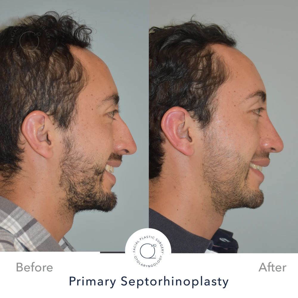 rinoplastia perfil lateral caso 28