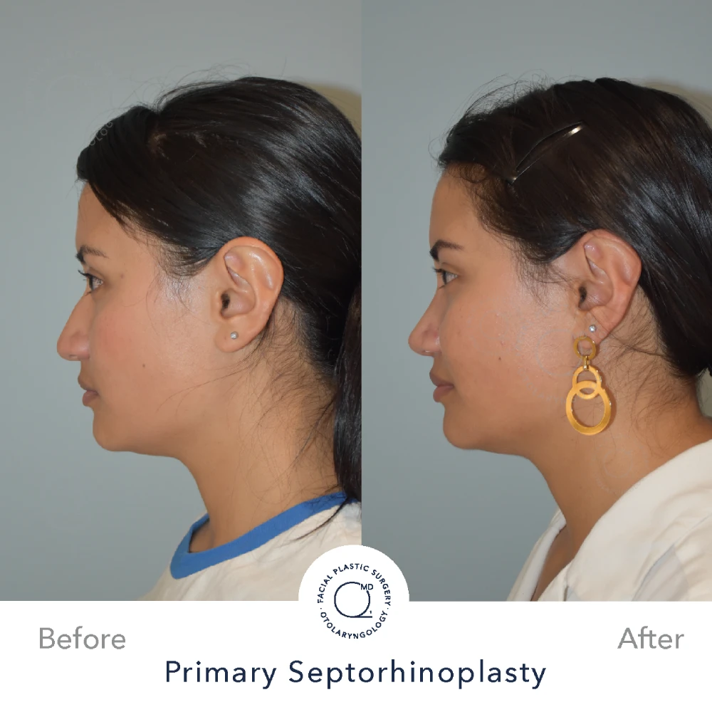 rinoplastia-perfil-lateral-caso-30