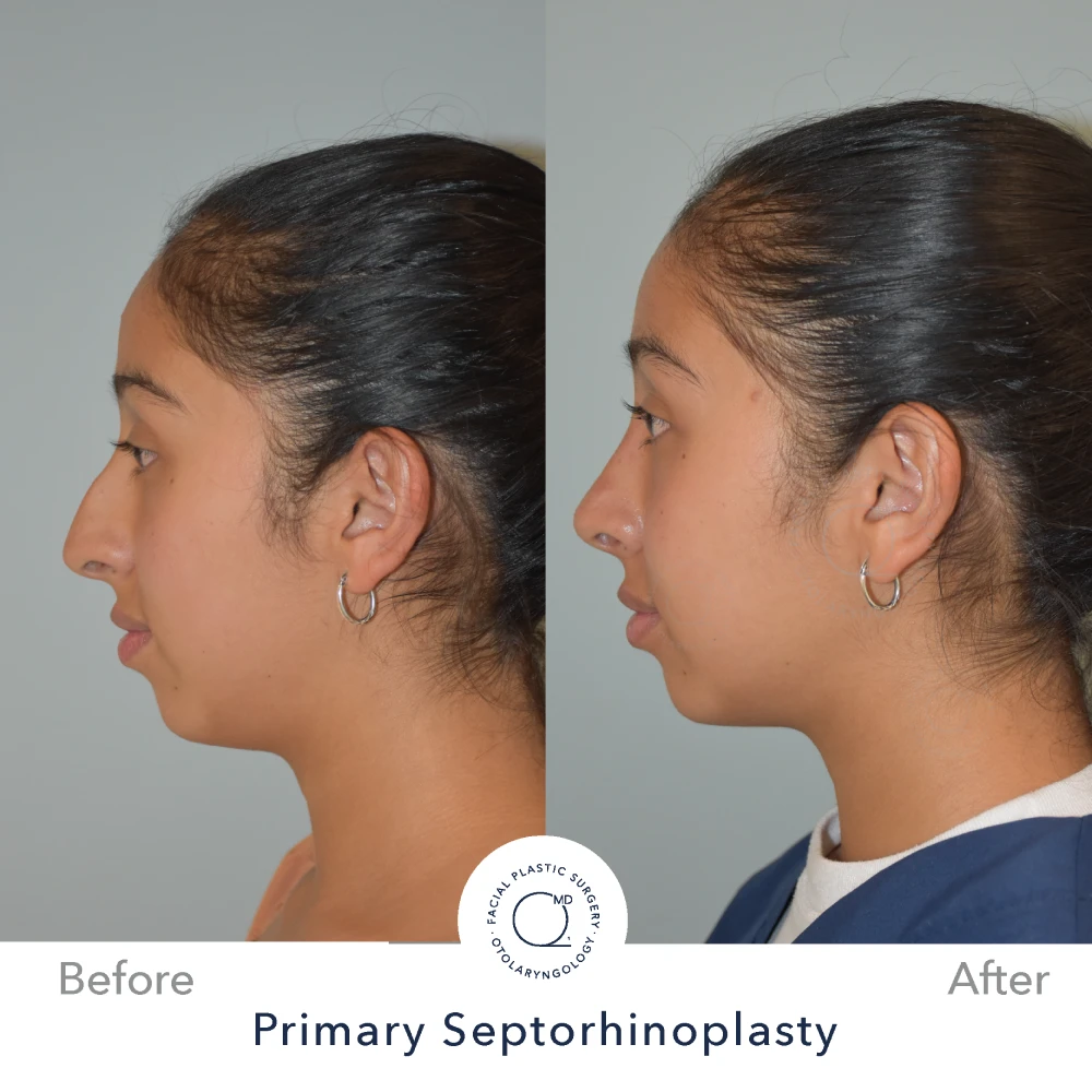 rinoplastia-perfil-lateral-caso-31