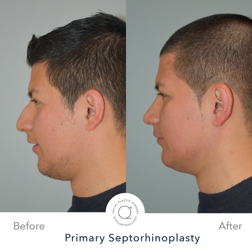 rinoplastia-perfil-lateral-caso-32