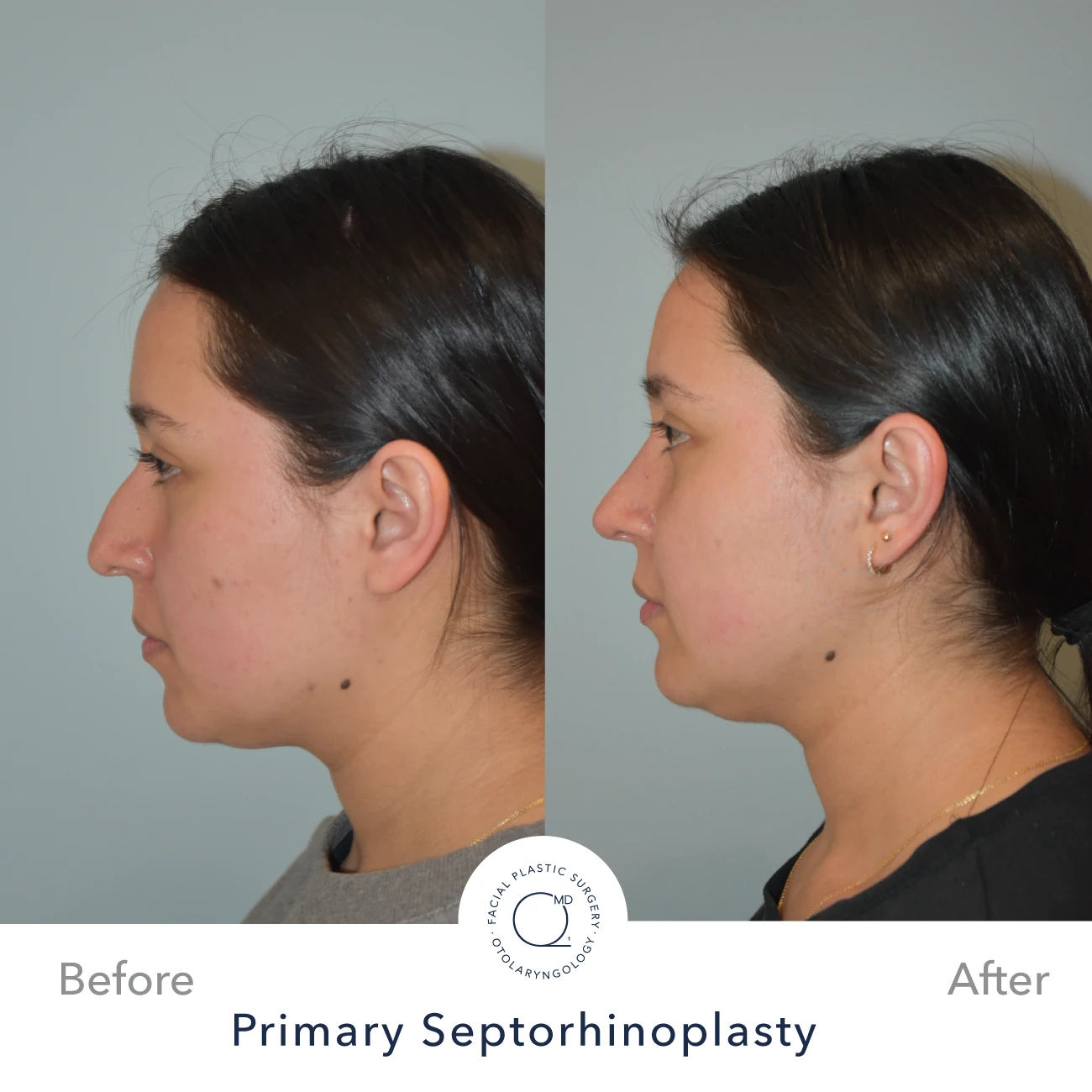 rinoplastia-perfil-lateral-caso-33