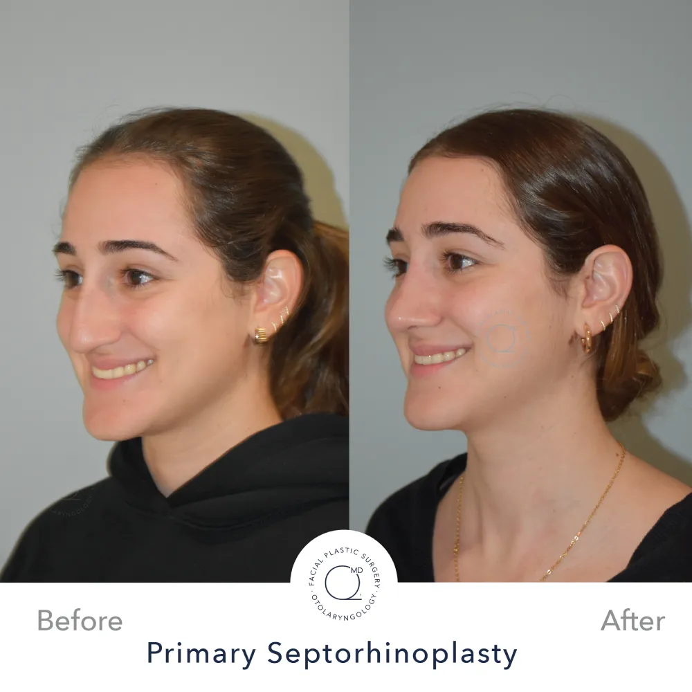 rinoplastia-perfil-lateral-caso-34