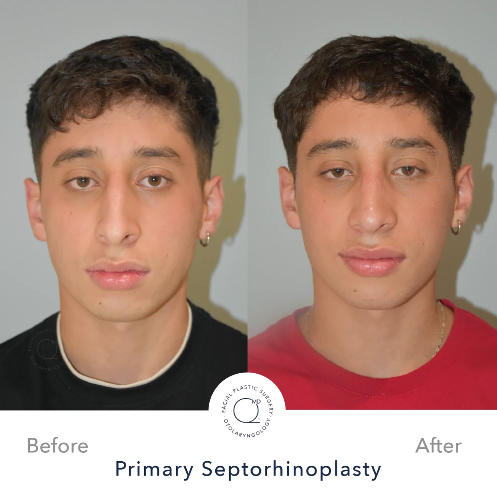 rinoplastia-perfil-lateral-caso-35