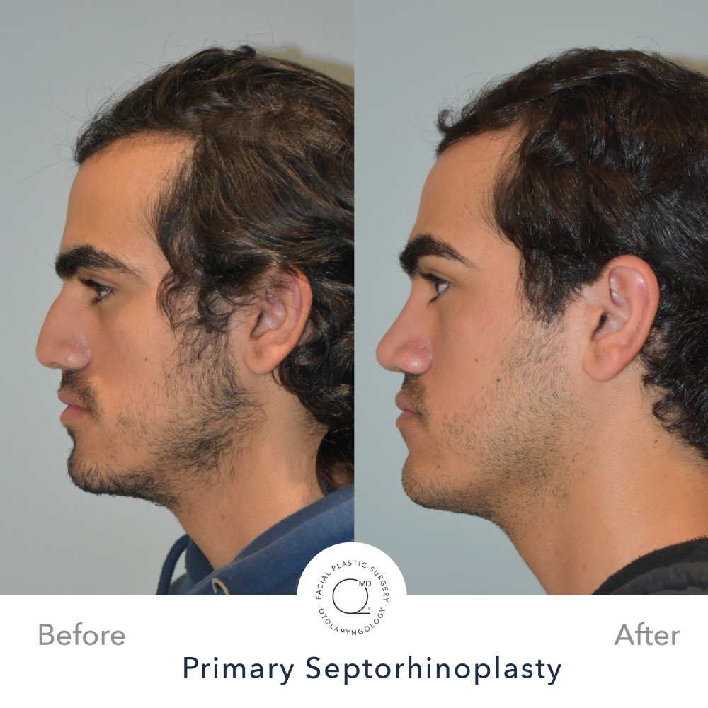 rinoplastia-perfil-lateral-caso-36