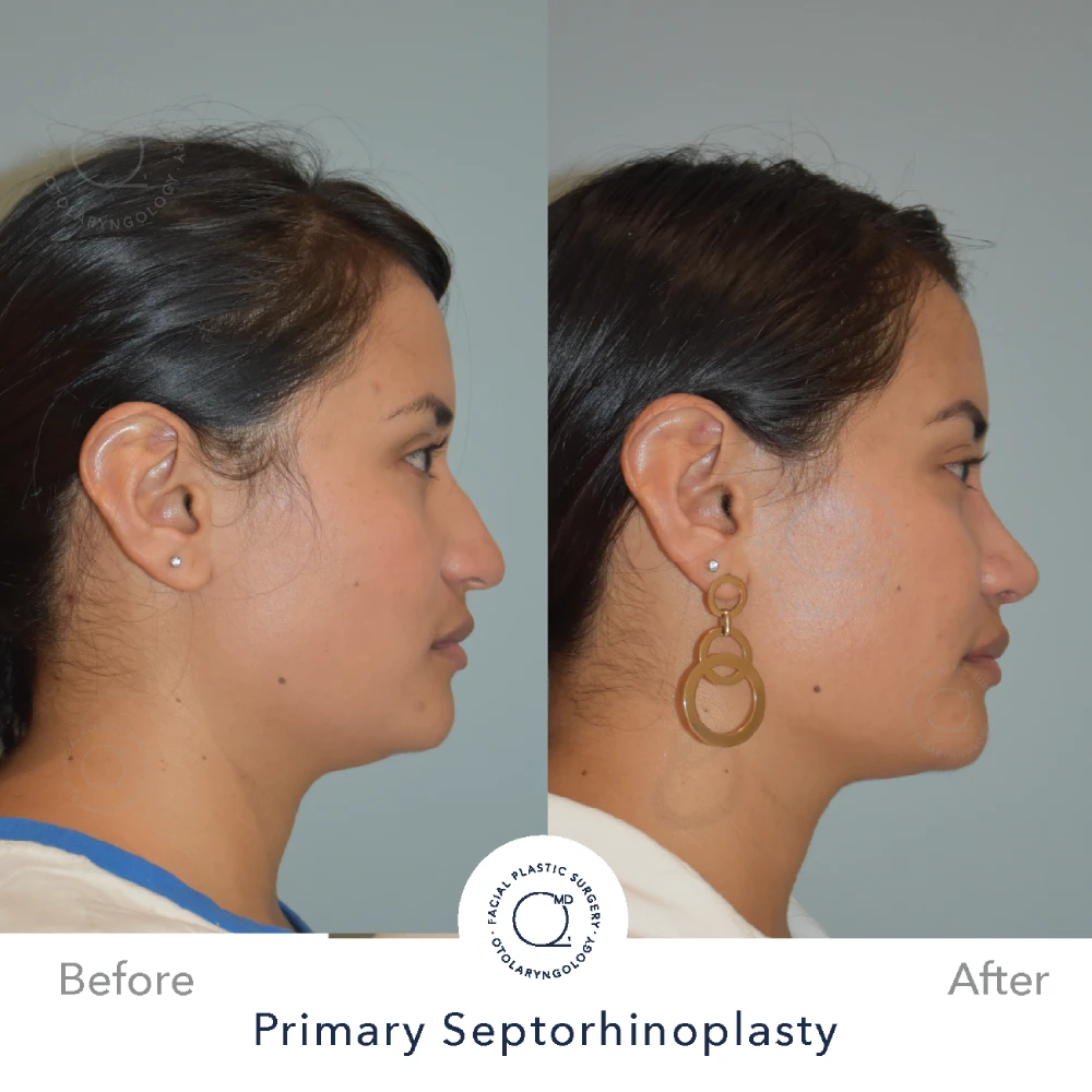 rinoplastia-perfil-simu-caso-30