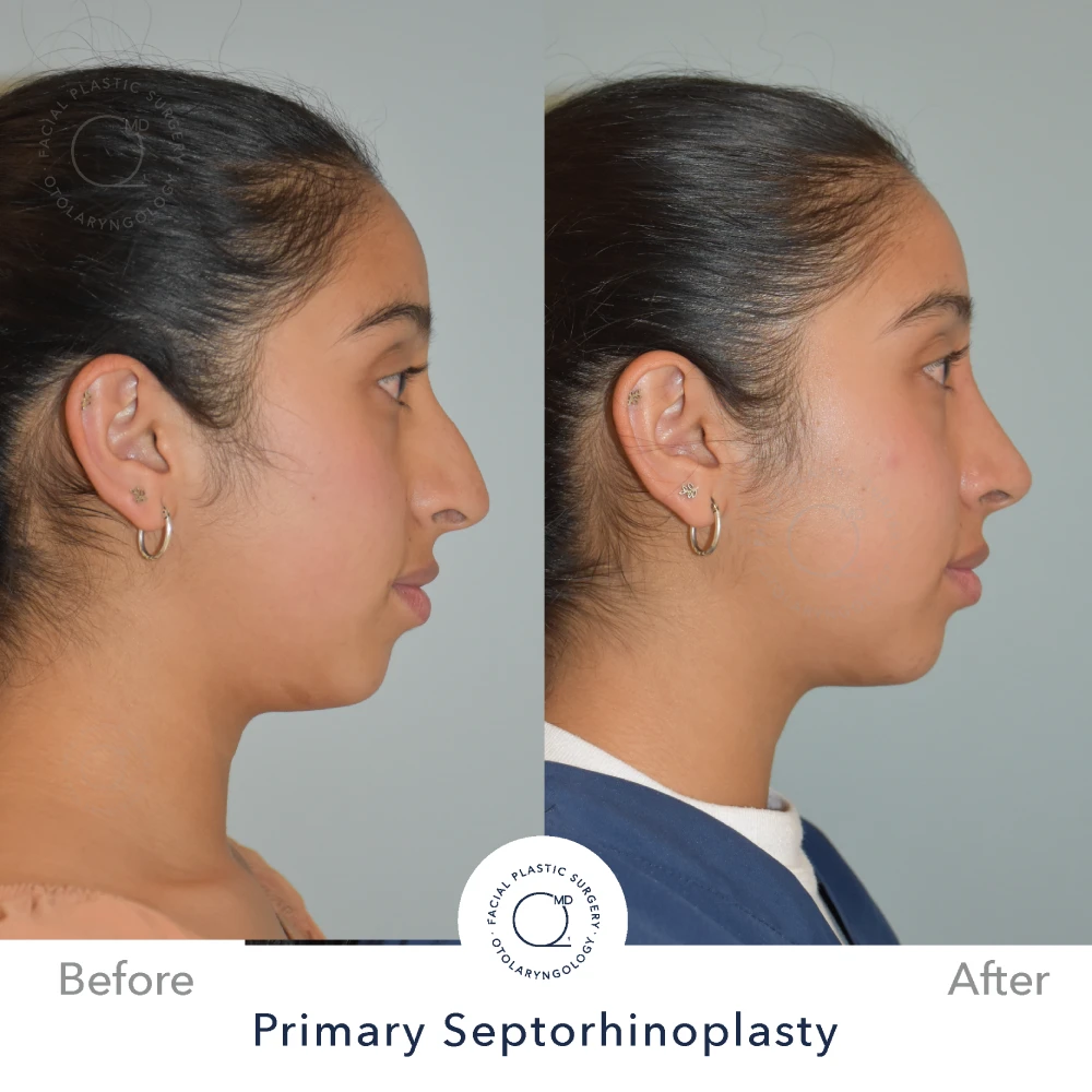 rinoplastia-perfil-simu-caso-31