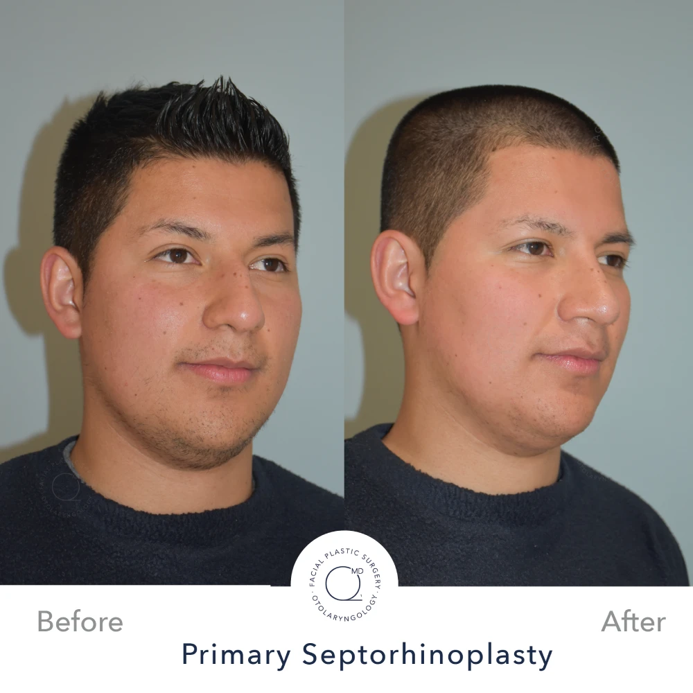 rinoplastia-perfil-simu-caso-32