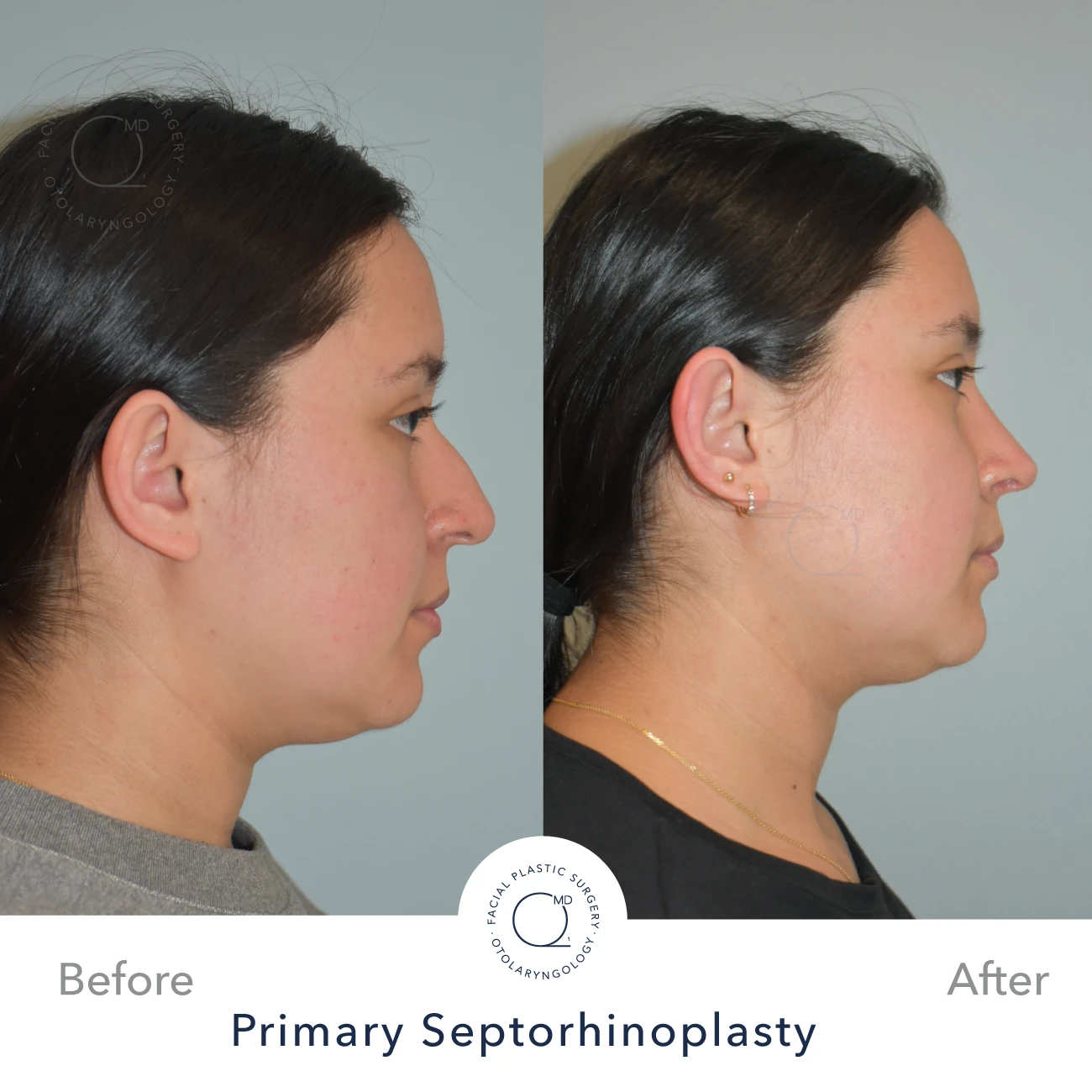 rinoplastia-perfil-simu-caso-33