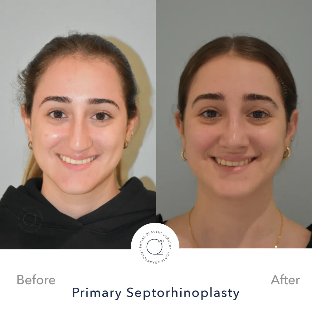 rinoplastia-perfil-simu-caso-34