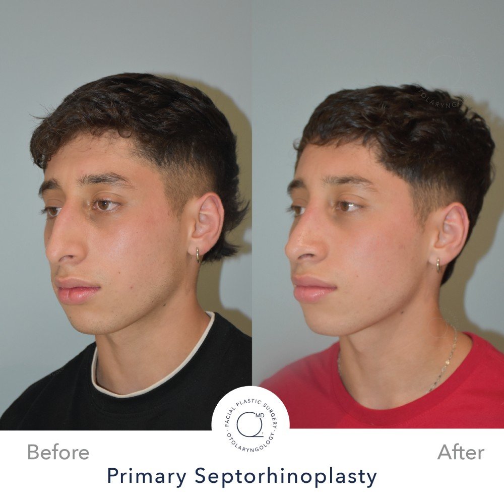 rinoplastia-perfil-simu-caso-35