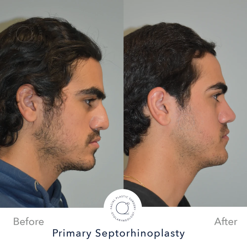 rinoplastia-perfil-simu-caso-36