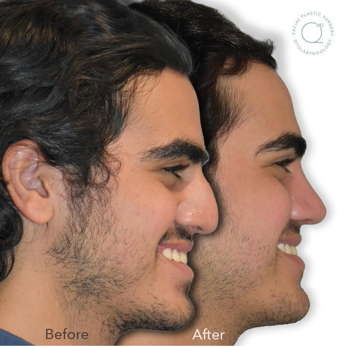Caso clínico autorizado de rinoplastia secundaria: antes y después
