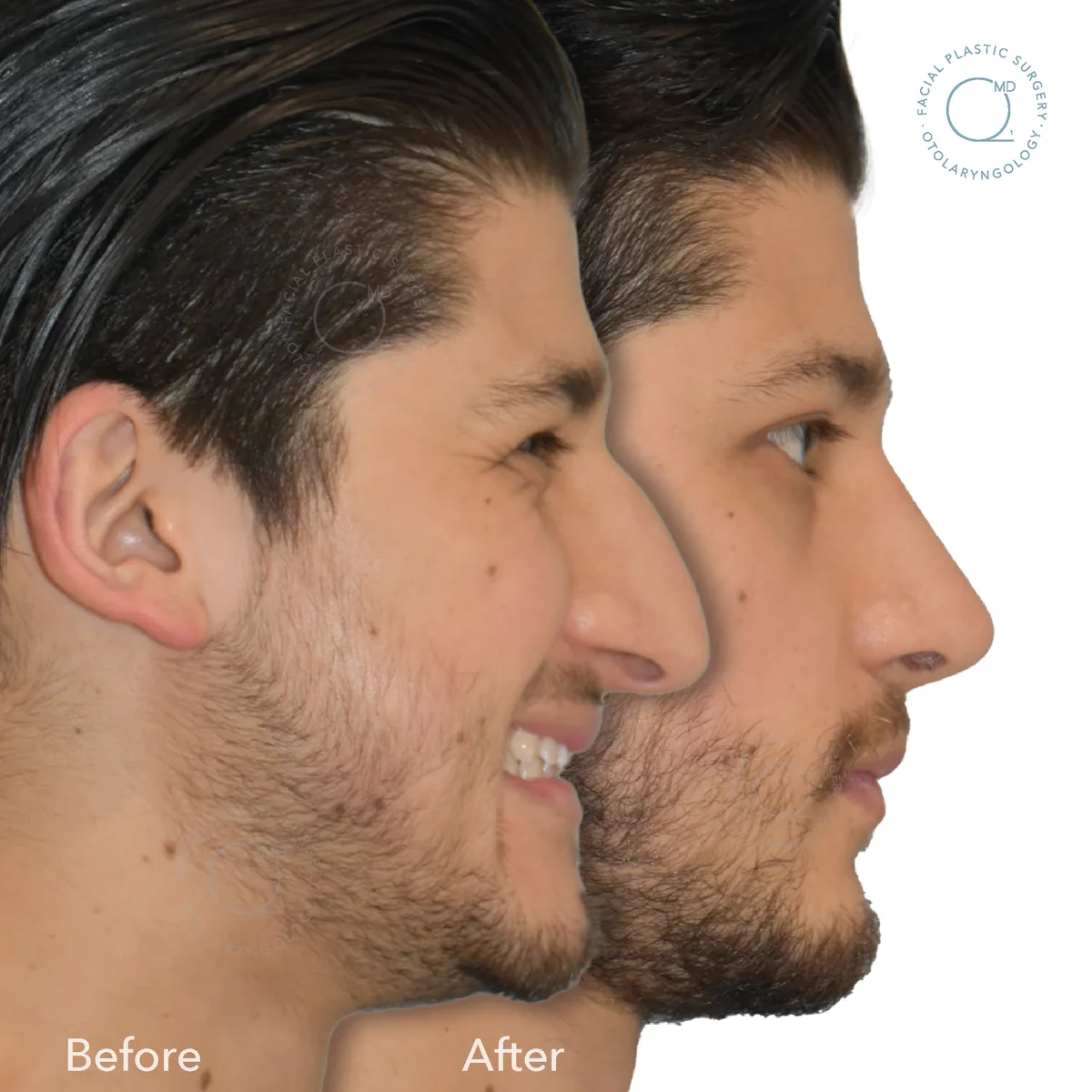 Rinoplastia cerrada antes y después realizada por el Dr. Jorge Duque Silva